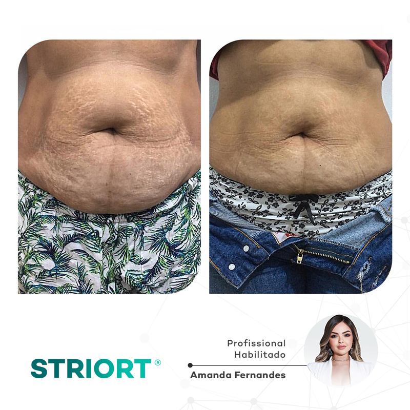 Antes e depois — abdômen, profissional Amanda Fernandes