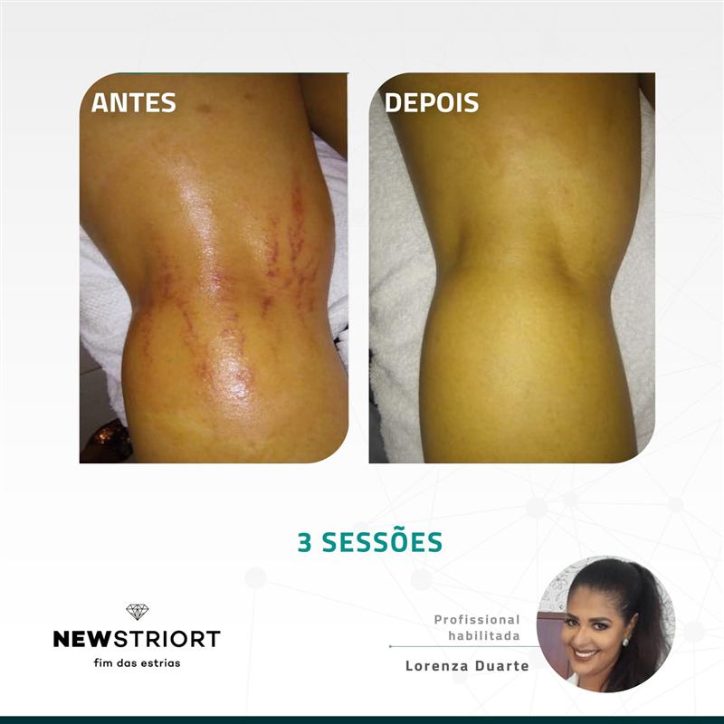 Antes e depois — 3 sessões, profissional Lorenza Duarte