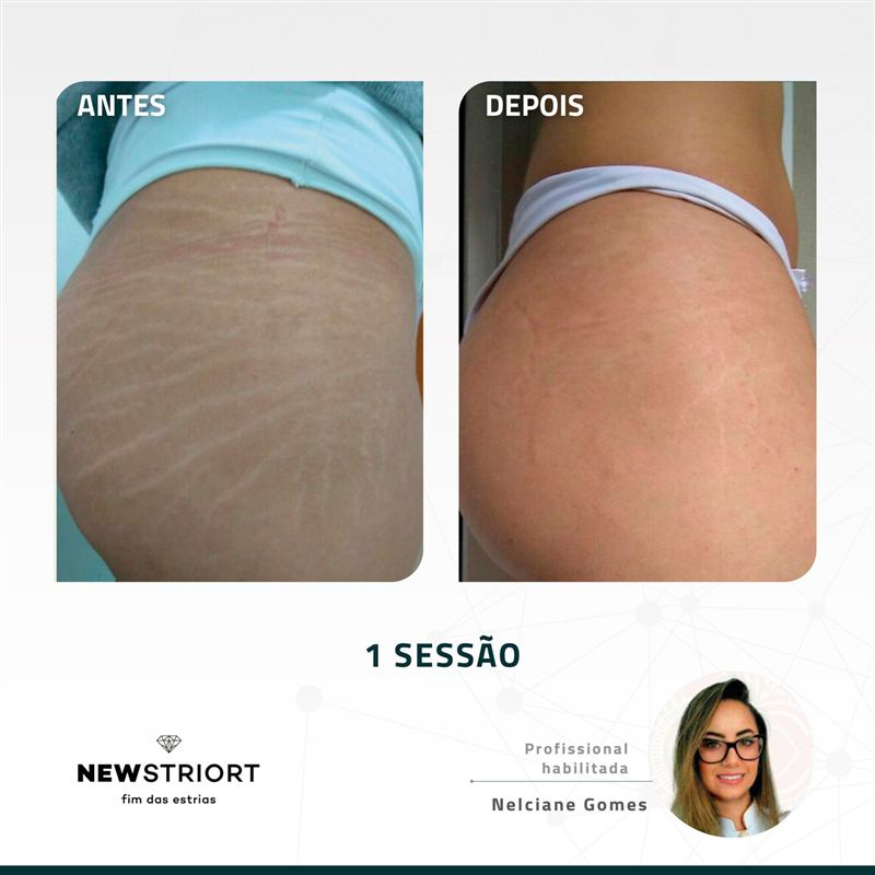 Antes e depois — 1 sessão, profissional Nelciane Gomes