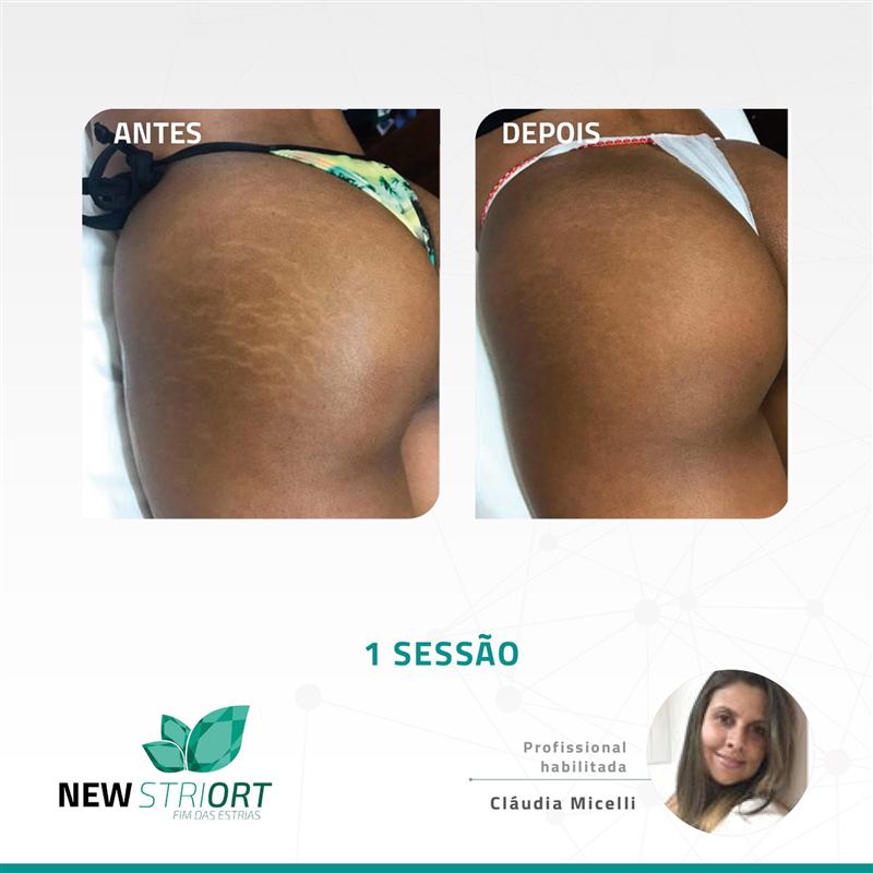 Antes e depois — 1 sessão, profissional Cláudia Micelli