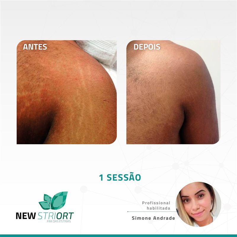Antes e depois — ombro masculino, 1 sessão, profissional Simone Andrade