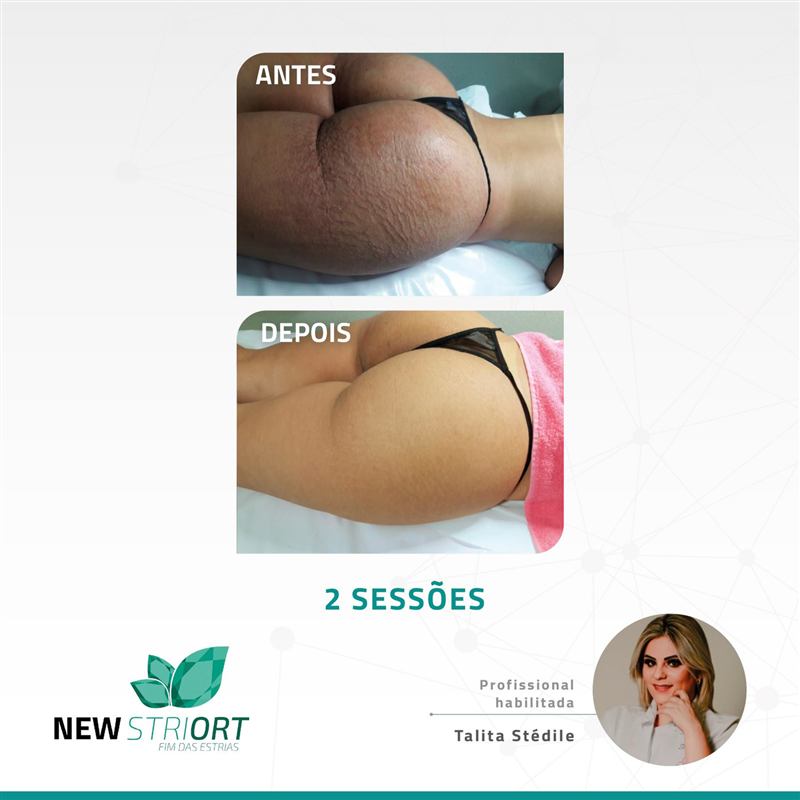 Antes e depois — 2 sessões, profissional Talita Stédile