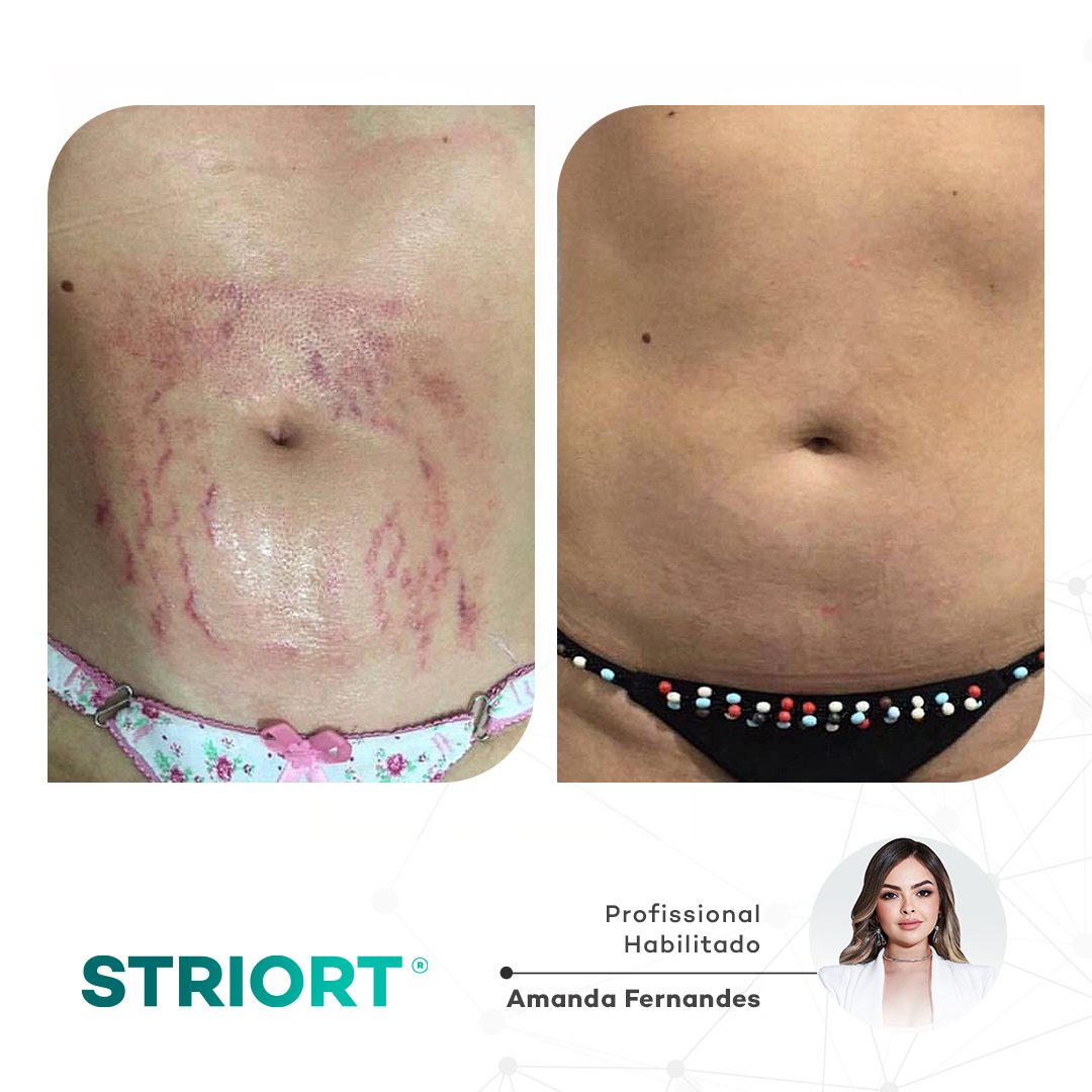 Antes e depois com o método STRIORT — Book de Resultados