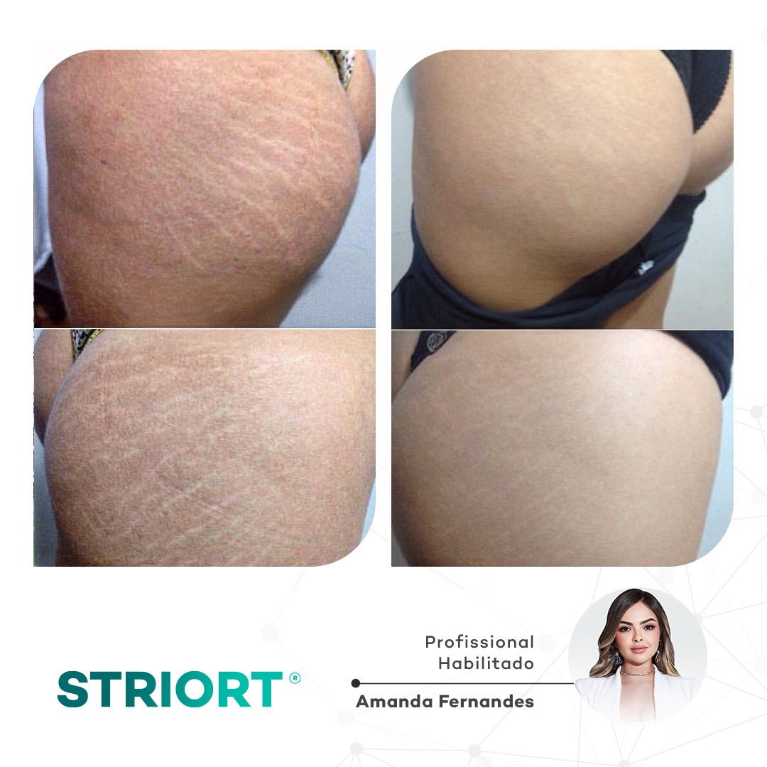 Antes e depois com o método STRIORT — Book de Resultados