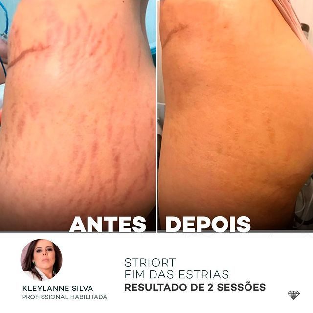 Antes e depois com o método STRIORT — Book de Resultados