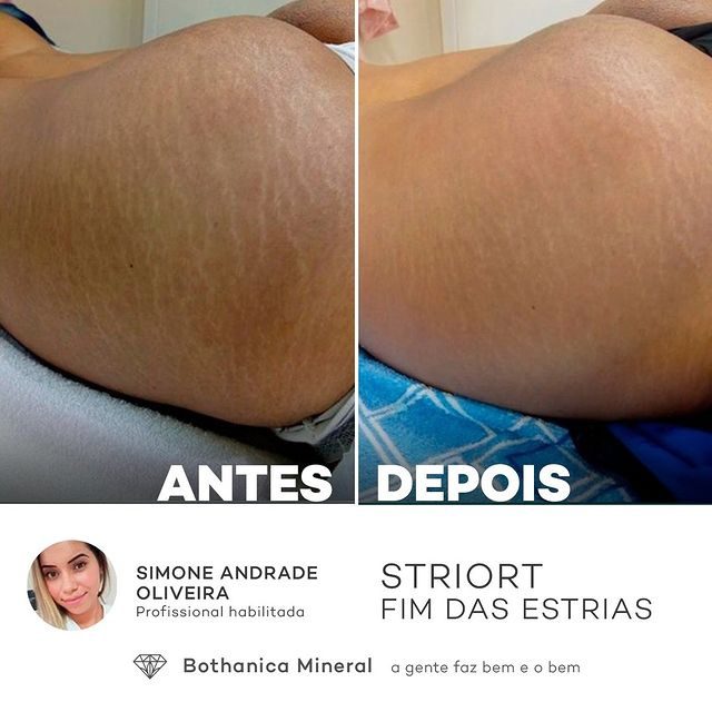 Antes e depois com o método STRIORT — Book de Resultados