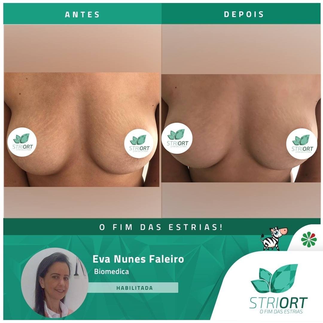Antes e depois com o método STRIORT — Book de Resultados
