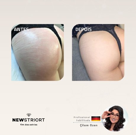 Antes e depois com o método STRIORT — Book de Resultados
