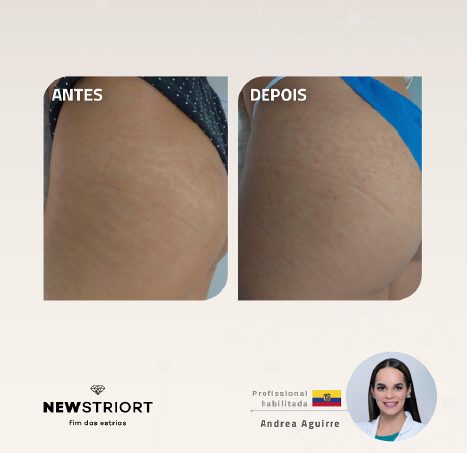 Antes e depois com o método STRIORT — Book de Resultados