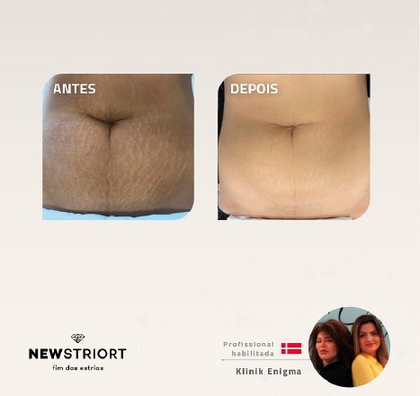 Antes e depois com o método STRIORT — Book de Resultados