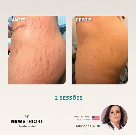 Antes e depois com o método STRIORT — Book de Resultados