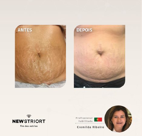 Antes e depois com o método STRIORT — Book de Resultados