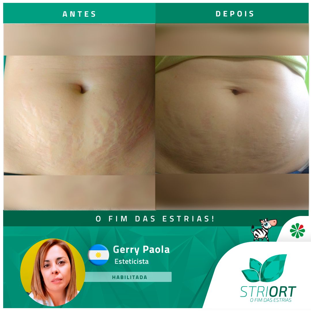Antes e depois com o método STRIORT — Book de Resultados