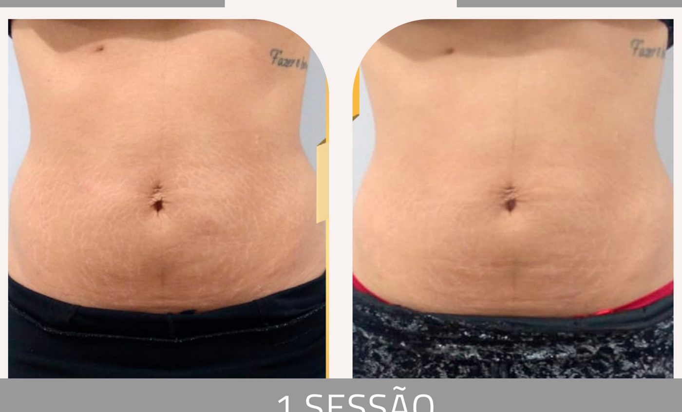 Antes e depois com o método STRIORT — Apresentação Oficial Bothanica Mineral