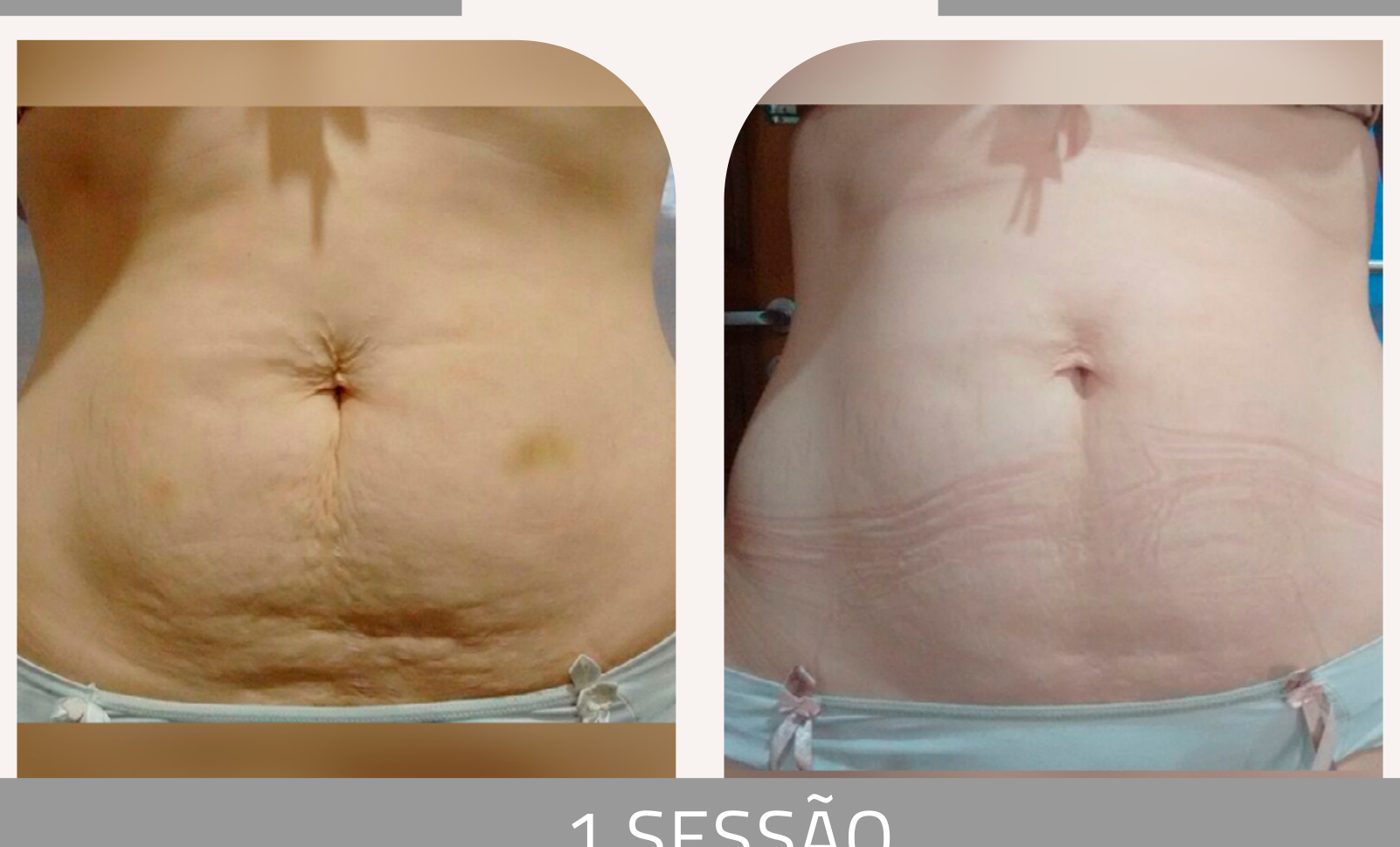 Antes e depois com o método STRIORT — Apresentação Oficial Bothanica Mineral