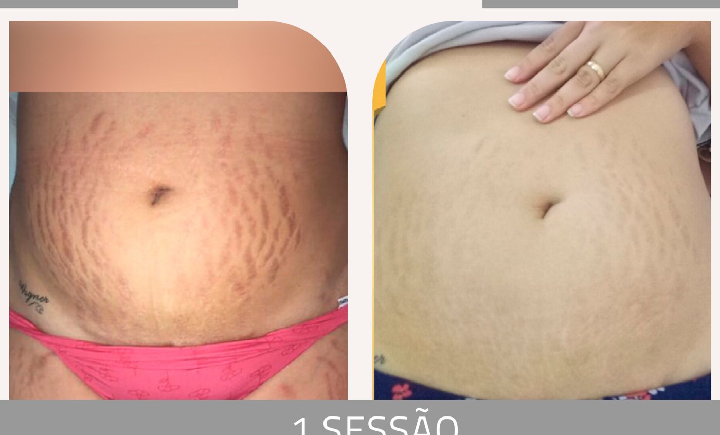 Antes e depois com o método STRIORT — Apresentação Oficial Bothanica Mineral