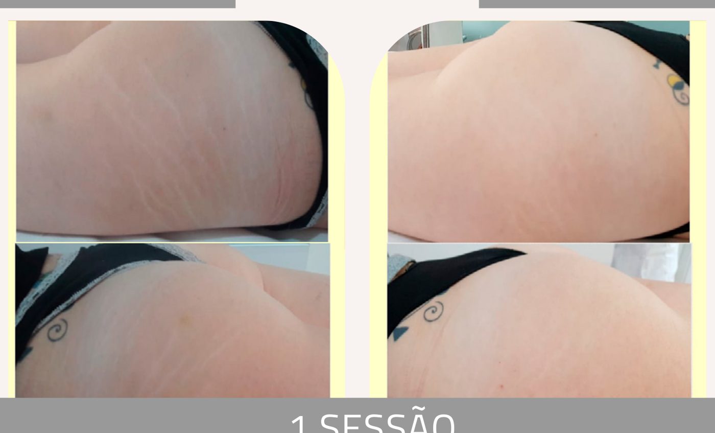 Antes e depois com o método STRIORT — Apresentação Oficial Bothanica Mineral
