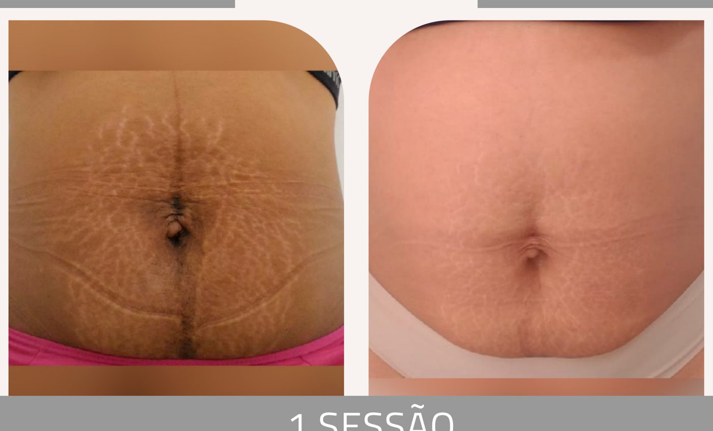 Antes e depois com o método STRIORT — Apresentação Oficial Bothanica Mineral