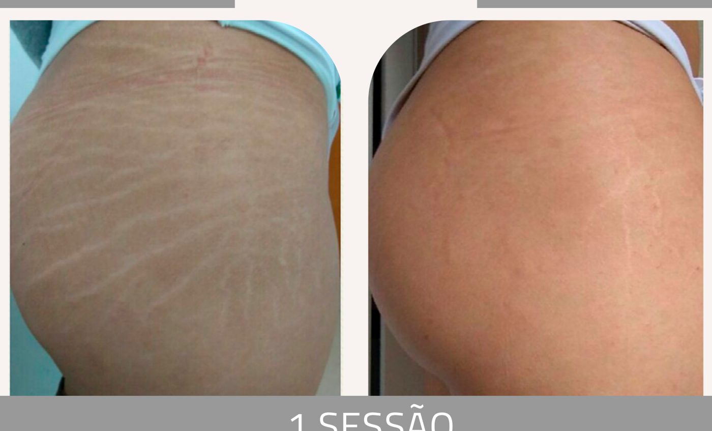 Antes e depois com o método STRIORT — Apresentação Oficial Bothanica Mineral