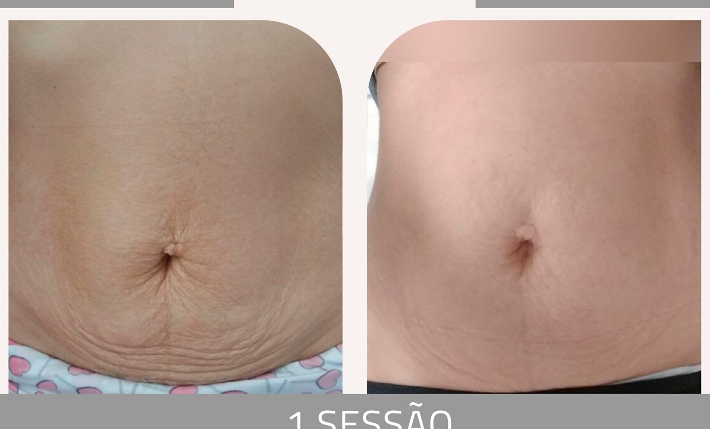 Antes e depois com o método STRIORT — Apresentação Oficial Bothanica Mineral