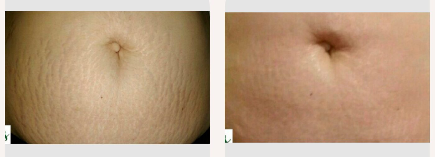Antes e depois com o método STRIORT — Apresentação Oficial Bothanica Mineral