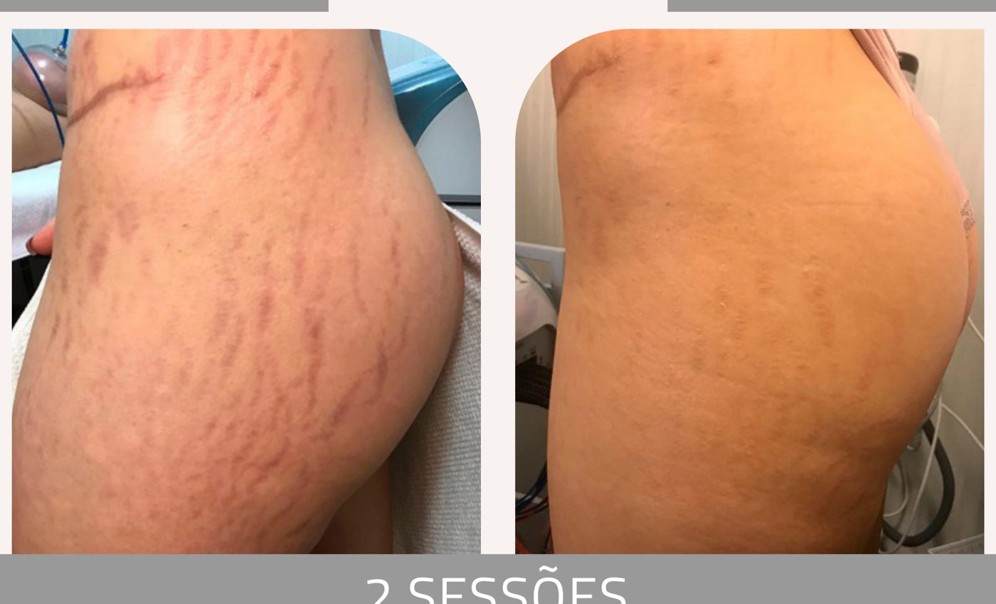 Antes e depois com o método STRIORT — Apresentação Oficial Bothanica Mineral