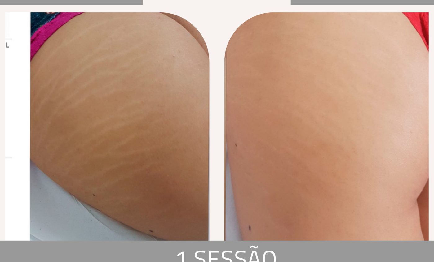 Antes e depois com o método STRIORT — Apresentação Oficial Bothanica Mineral