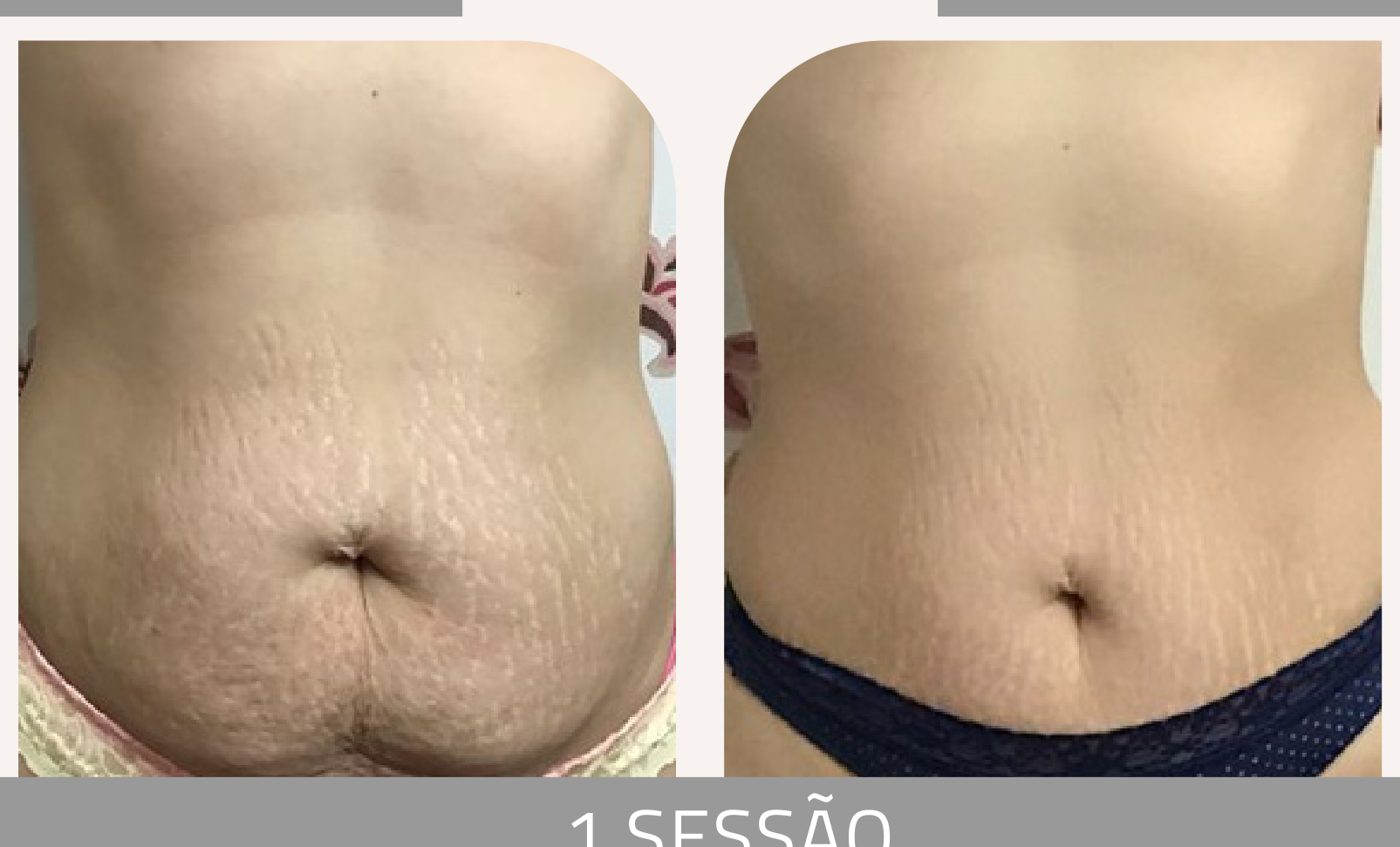 Antes e depois com o método STRIORT — Apresentação Oficial Bothanica Mineral