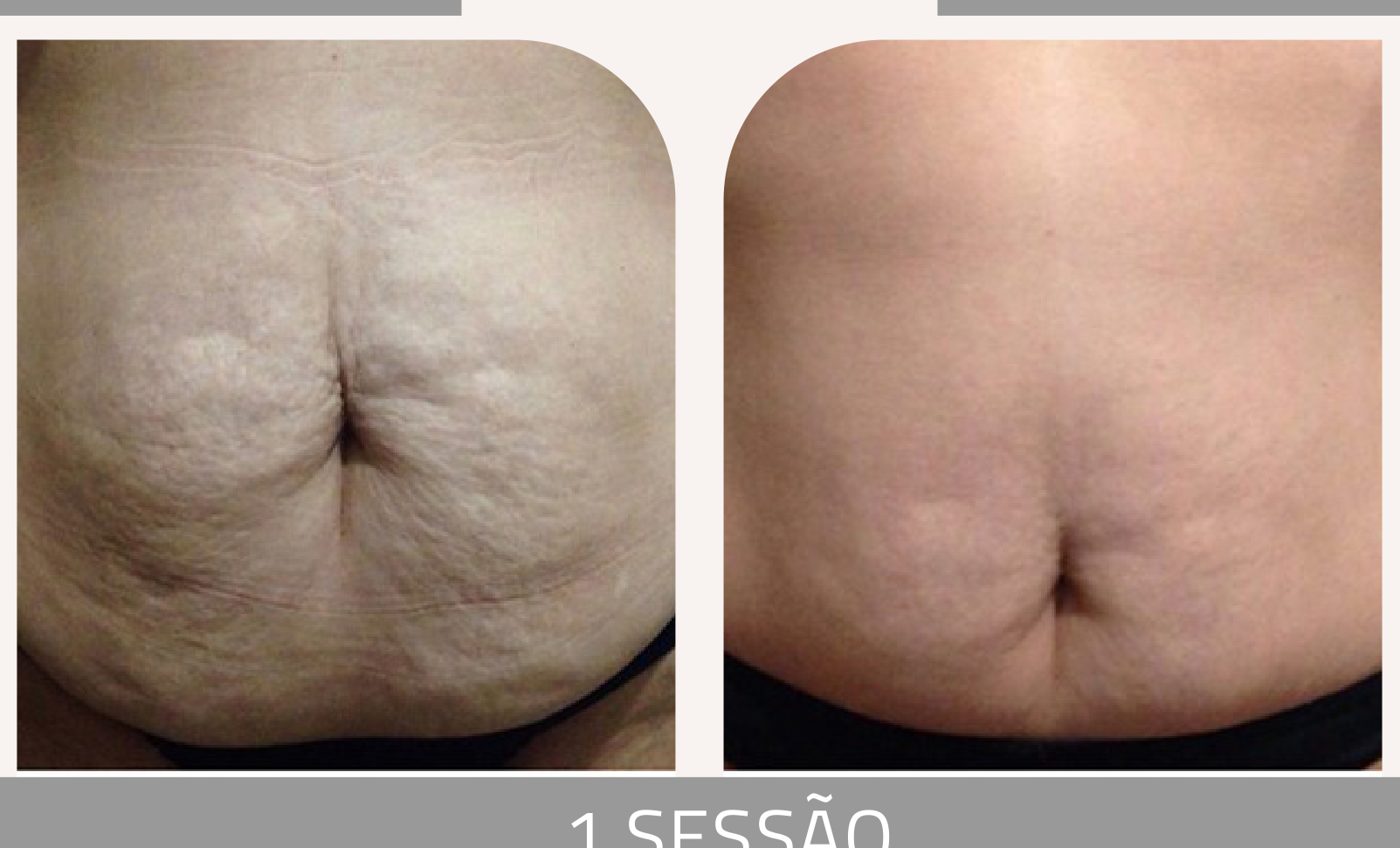 Antes e depois com o método STRIORT — Apresentação Oficial Bothanica Mineral