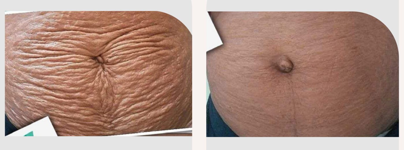 Antes e depois com o método STRIORT — Apresentação Oficial Bothanica Mineral