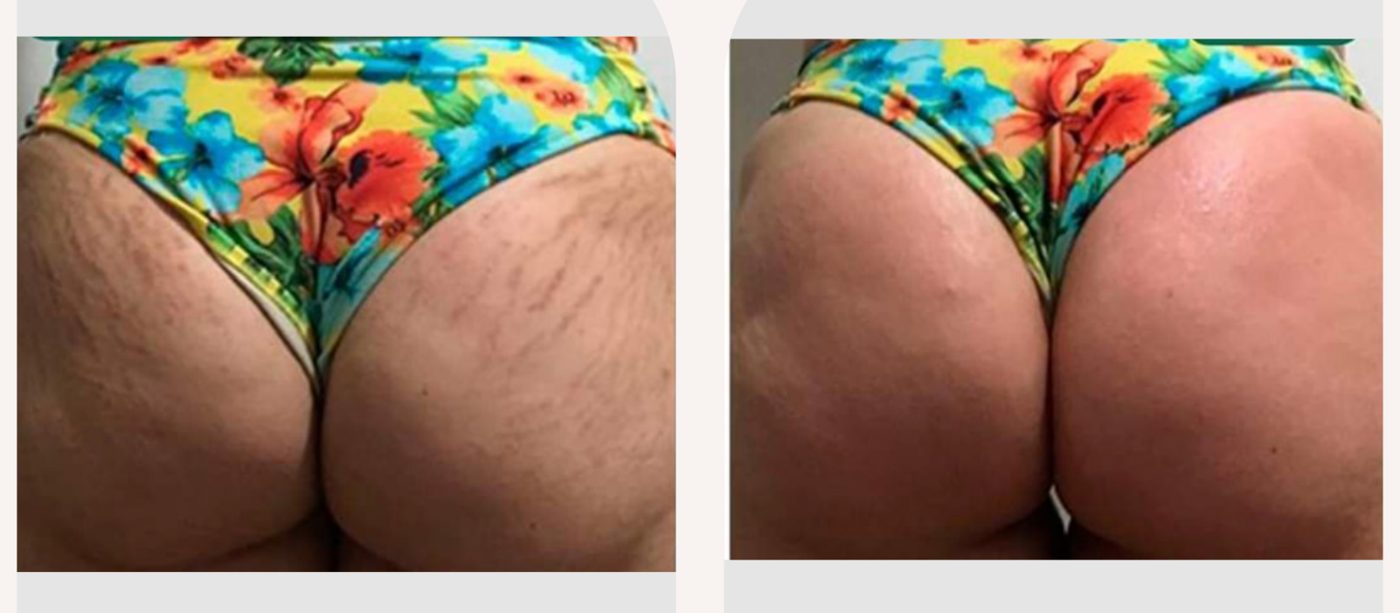Antes e depois com o método STRIORT — Apresentação Oficial Bothanica Mineral