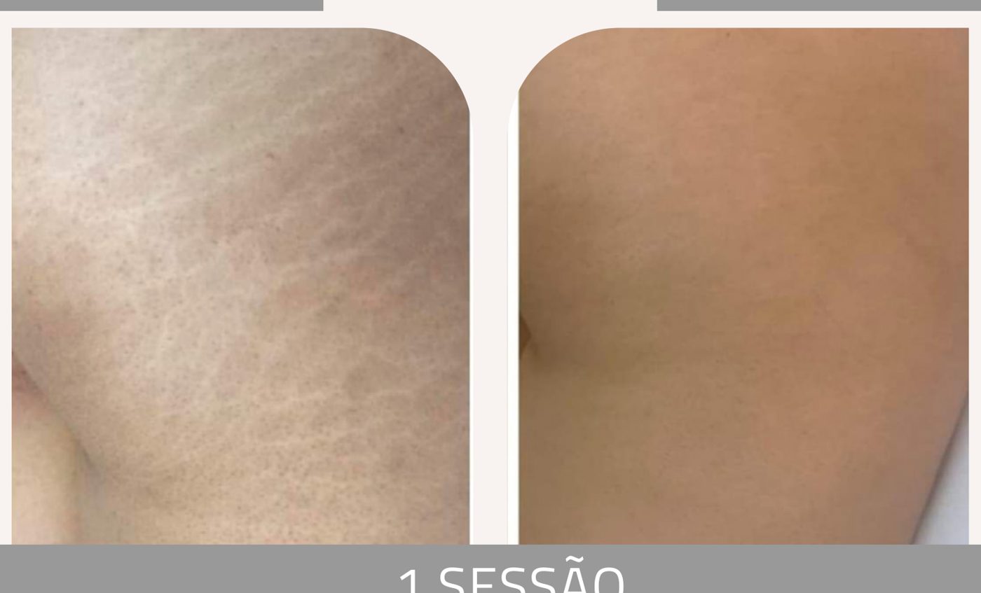 Antes e depois com o método STRIORT — Apresentação Oficial Bothanica Mineral