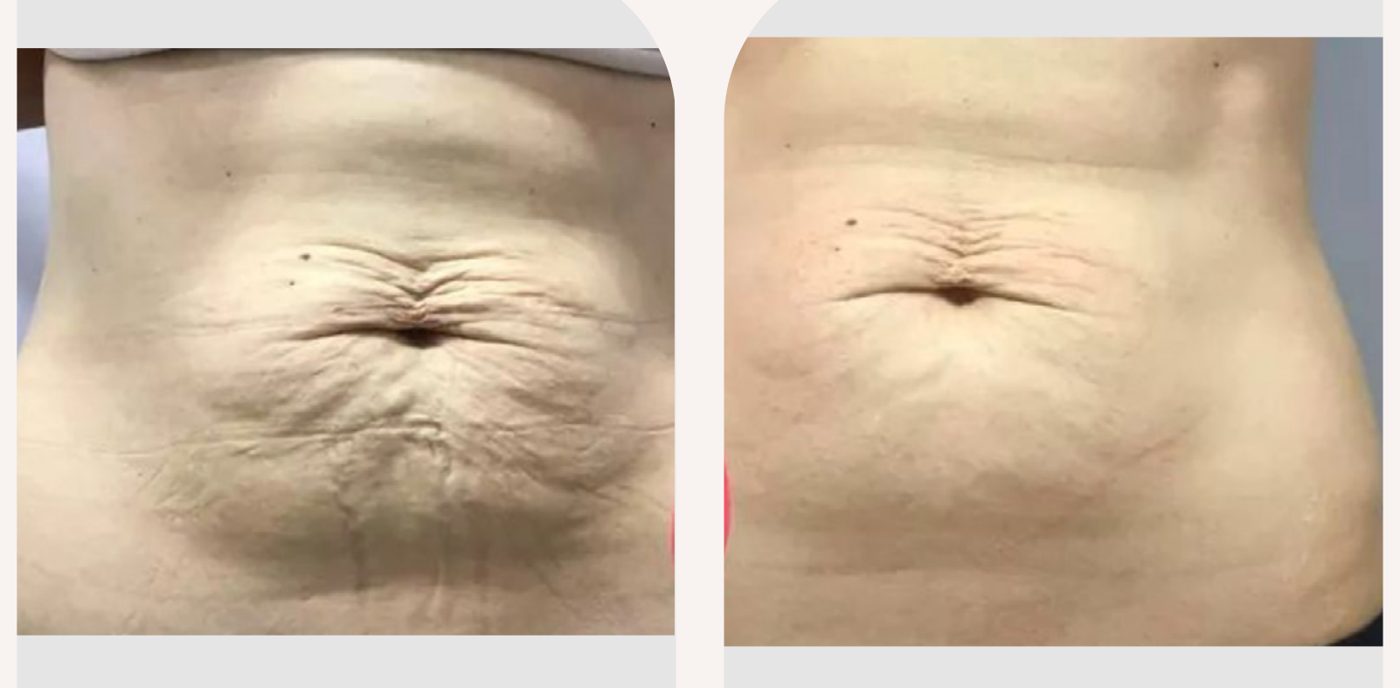 Antes e depois com o método STRIORT — Apresentação Oficial Bothanica Mineral