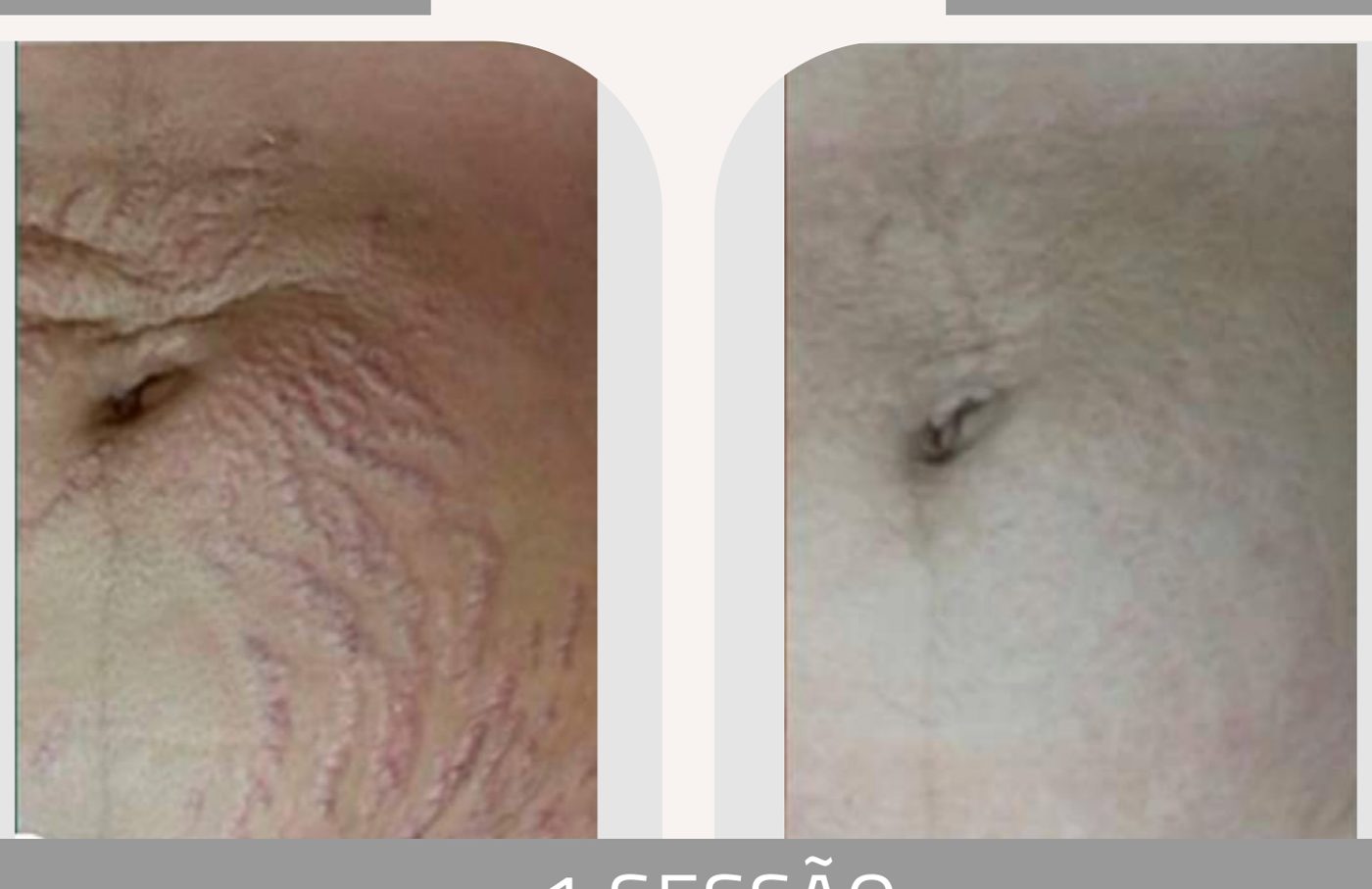 Antes e depois com o método STRIORT — Apresentação Oficial Bothanica Mineral