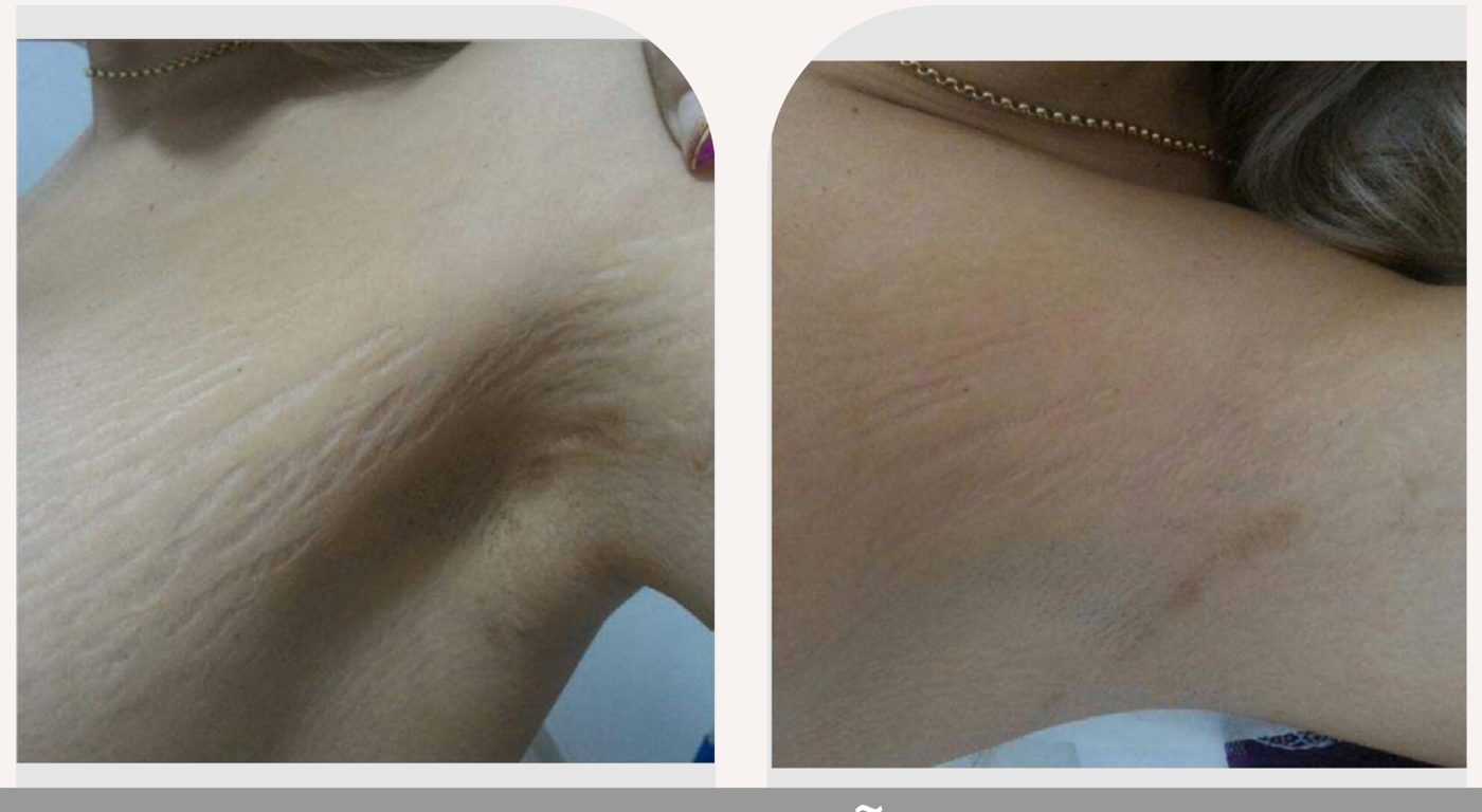 Antes e depois com o método STRIORT — Apresentação Oficial Bothanica Mineral