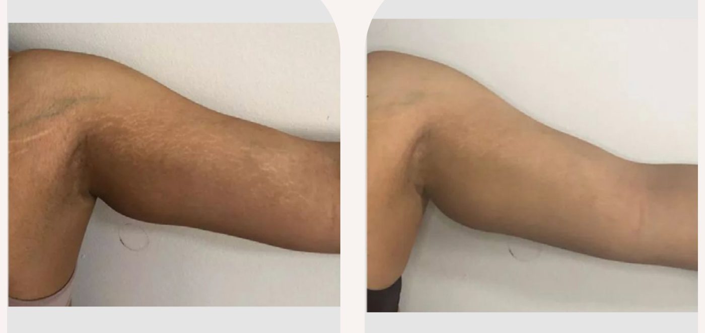 Antes e depois com o método STRIORT — Apresentação Oficial Bothanica Mineral