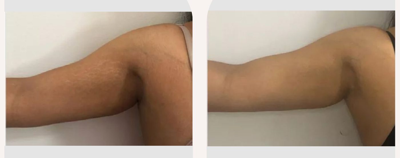 Antes e depois com o método STRIORT — Apresentação Oficial Bothanica Mineral